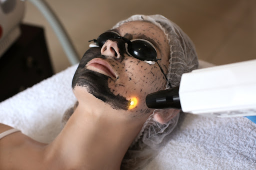 Carbon Facial laser treatment