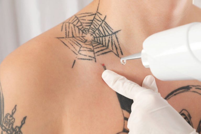 Shoulder Web Laser Tattoo Removal